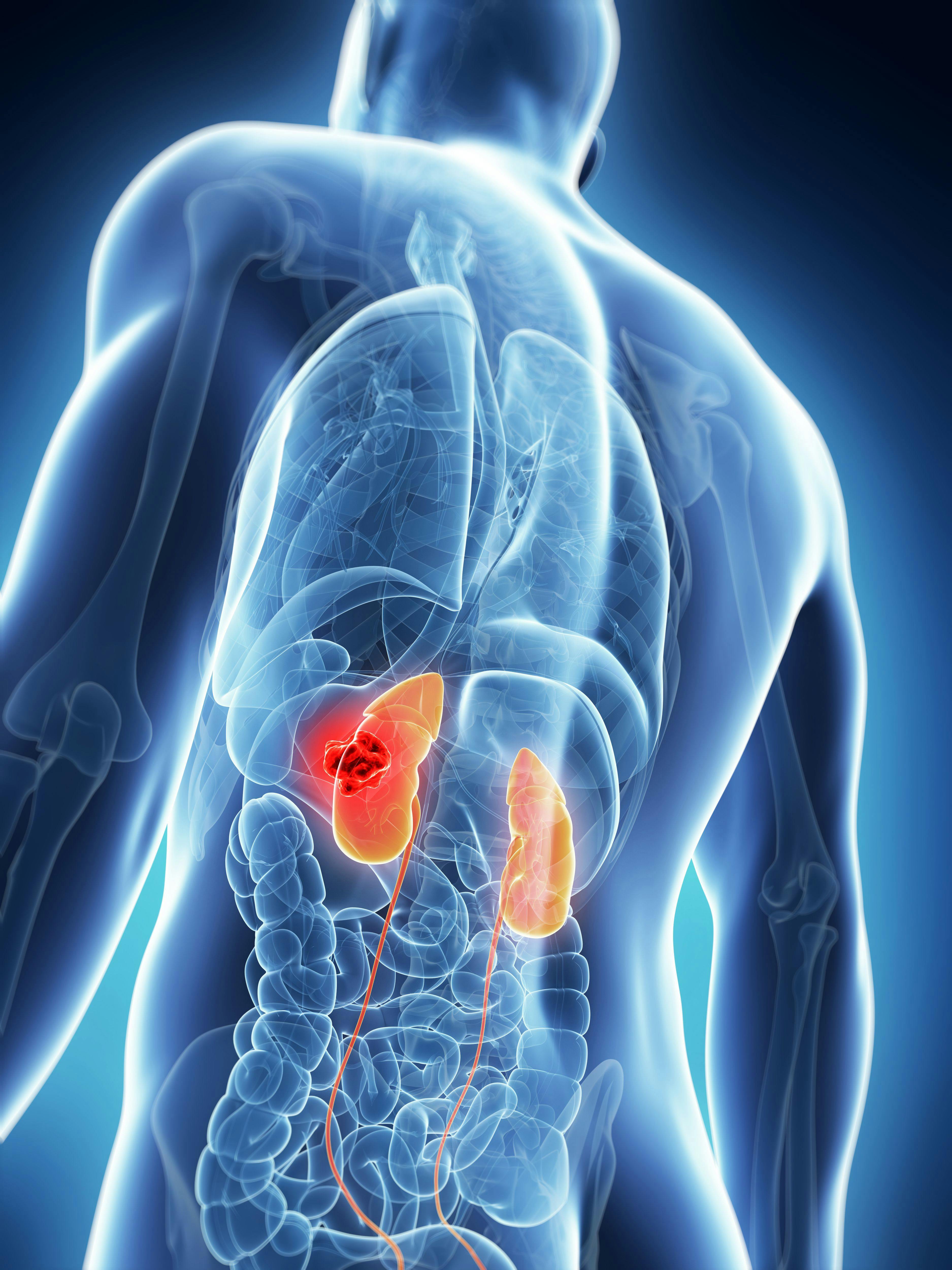Findings from the phase 3 KEYNOTE-564 trial support adjuvant pembrolizumab following nephrectomy as a standard-of-care treatment for patients with clear cell renal cell carcinoma.