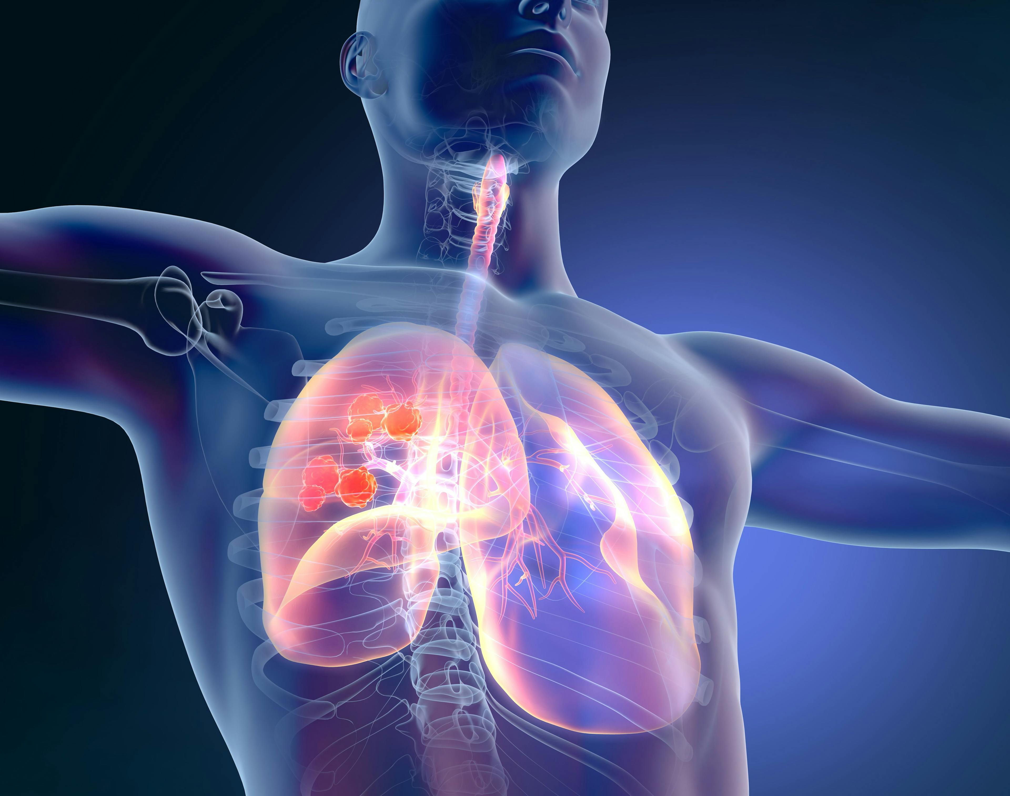 Preoperative CT Features May Help Select Patients With Stage IA NSCLC for Sublobar Resection
