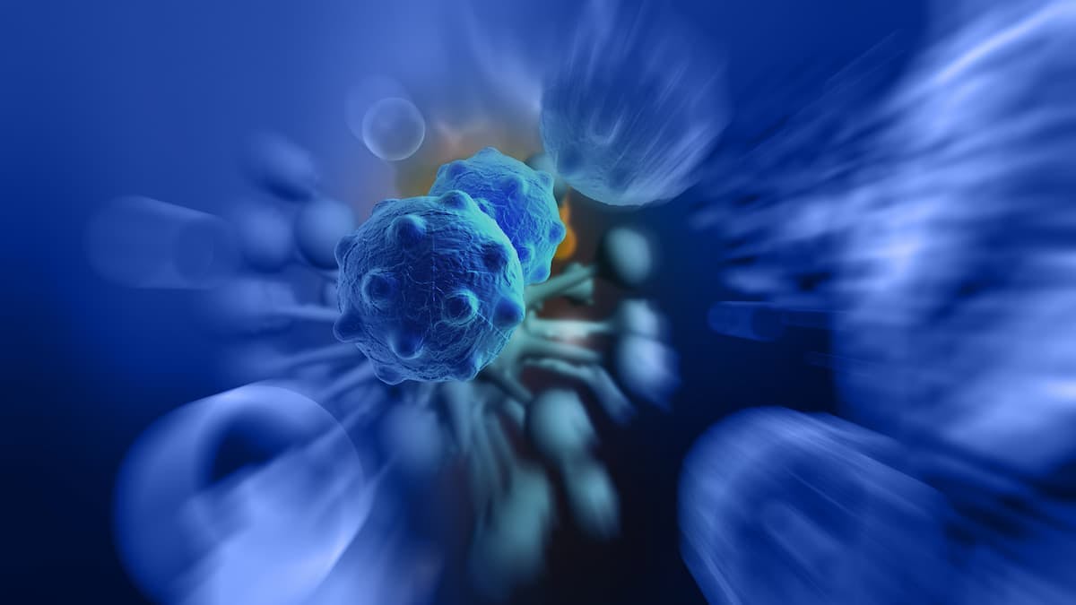 A study conducted by Mount Sinai investigators determined that the co-occurrence of t(4;14) and 1q gain was effective at identifying newly diagnosed patients with multiple myeloma who were at high risk of relapse.