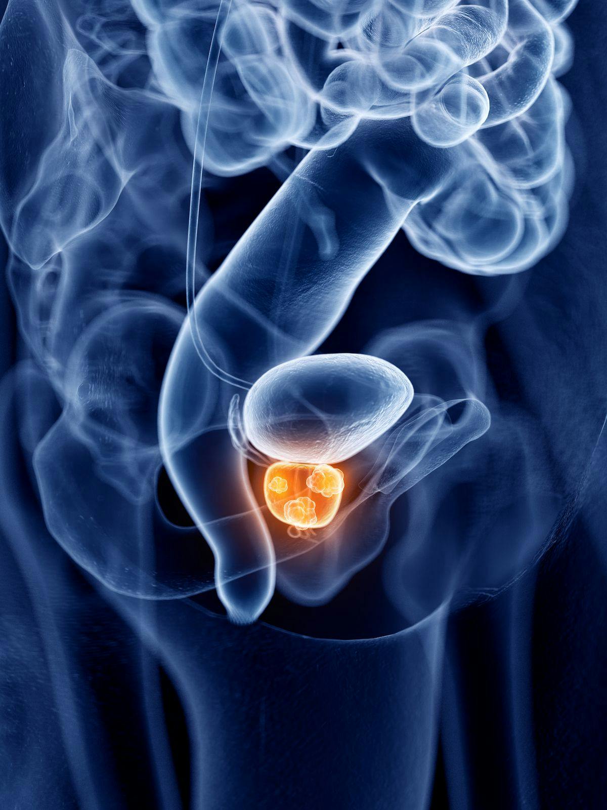 More research is needed to improve upon PSM for treating prostate cancer
