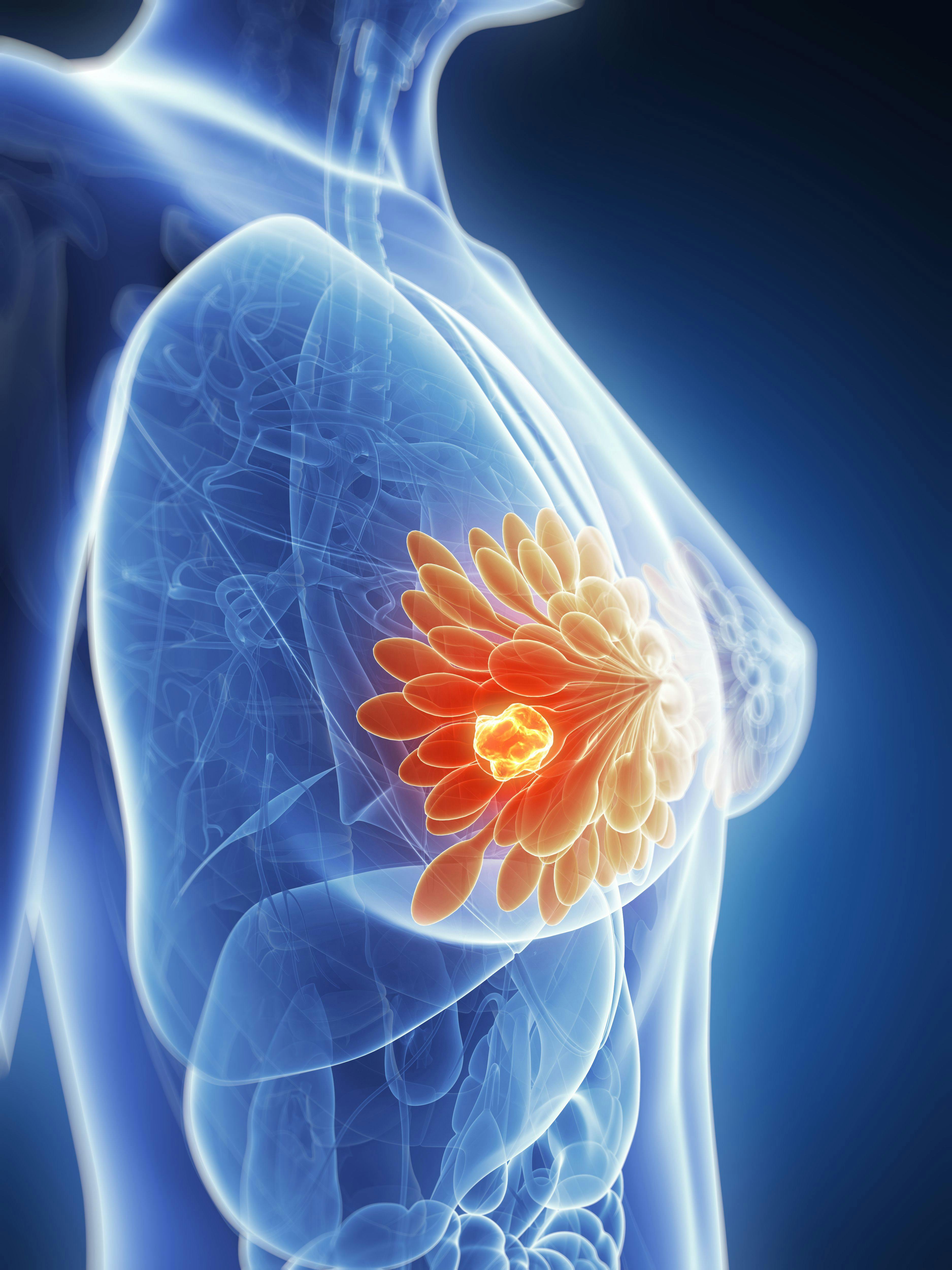 Patients with estrogen receptor–positive, HER2-negative advanced or metastatic breast cancer experienced a progression-free survival benefit after being treated with elacestrant.