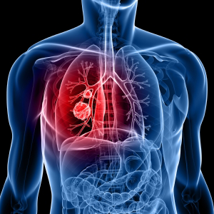 Higher Breath Temperature Could Signal Lung Cancer