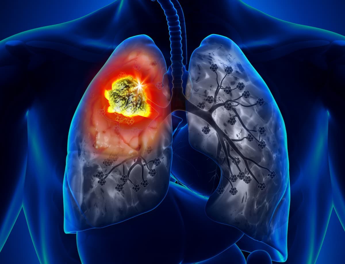 The CHMP recommended the approval of subcutaneous atezolizumab for all indications in which intravenous atezolizumab is currently approved; this includes lung, bladder, liver, and breast cancer. The European Commission is anticipated to make a regulatory decision on the approval of subcutaneous atezolizumab in the future.