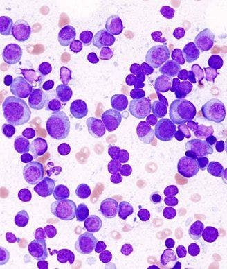 Engineered T Cells Elicit Clinical Response in Advanced Myeloma