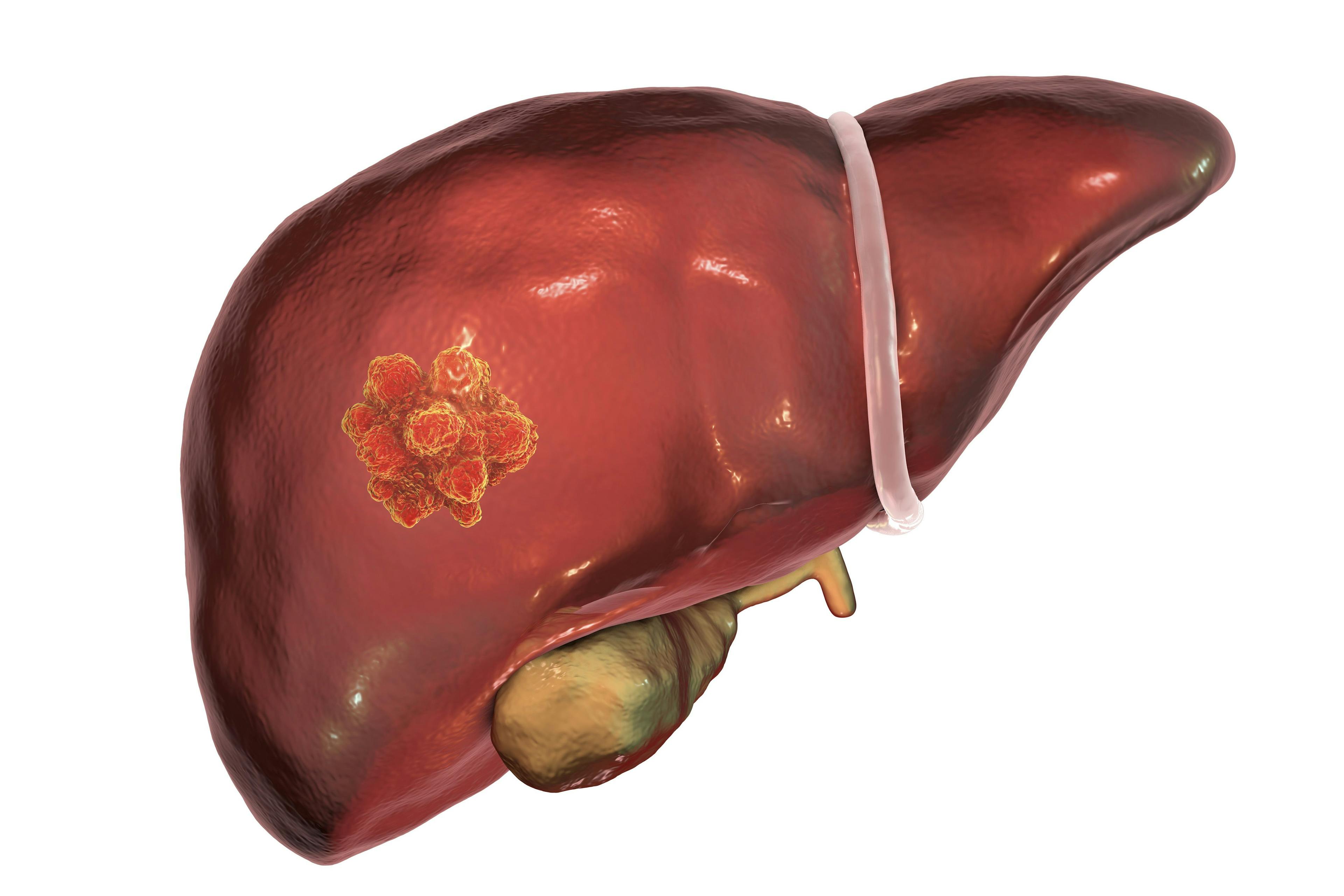 Developers are assessing the safety, tolerability, and preliminary efficacy of BST02 in patients with locally advanced or metastatic liver cancer in an investigator-initiated phase 1 trial (NCT06173726).