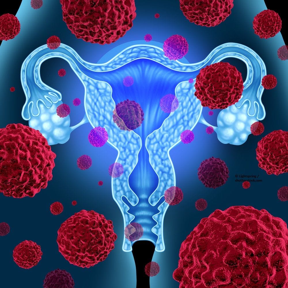 Tumor Vasculature Remains Stable Through Progression of Ovarian Cancer