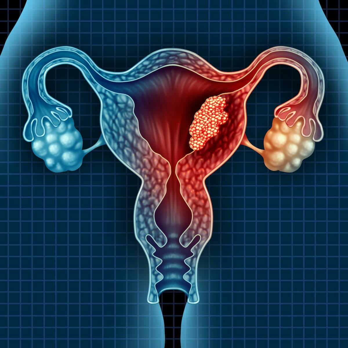 “Today’s European Commission approval is welcomed news, as I believe it will define a new standard of care for certain patients with advanced or recurrent endometrial cancer in the [European Union],” according toMansoor Raza Mirza, MD.