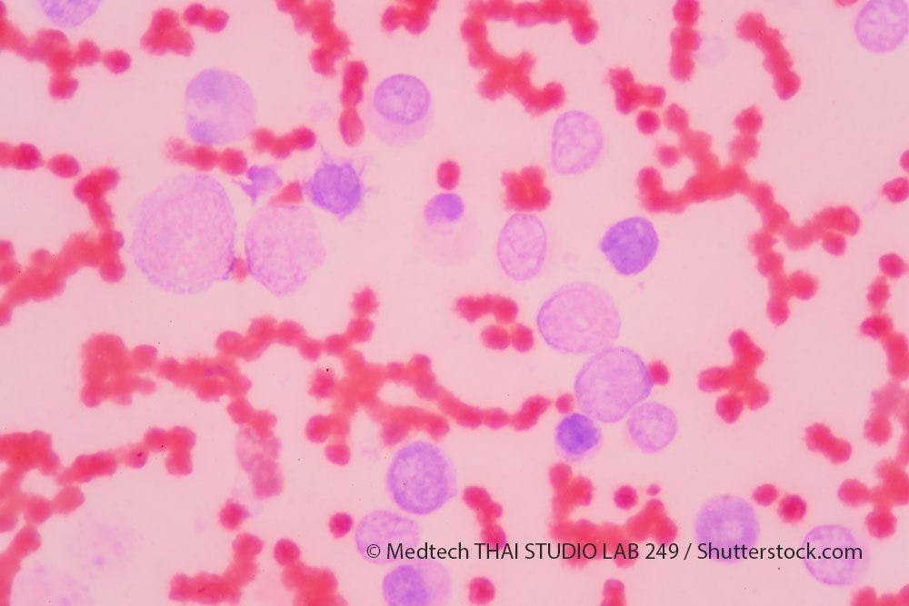 SY-1425 Combination Shows Promise in Acute Myeloid Leukemia Subgroup