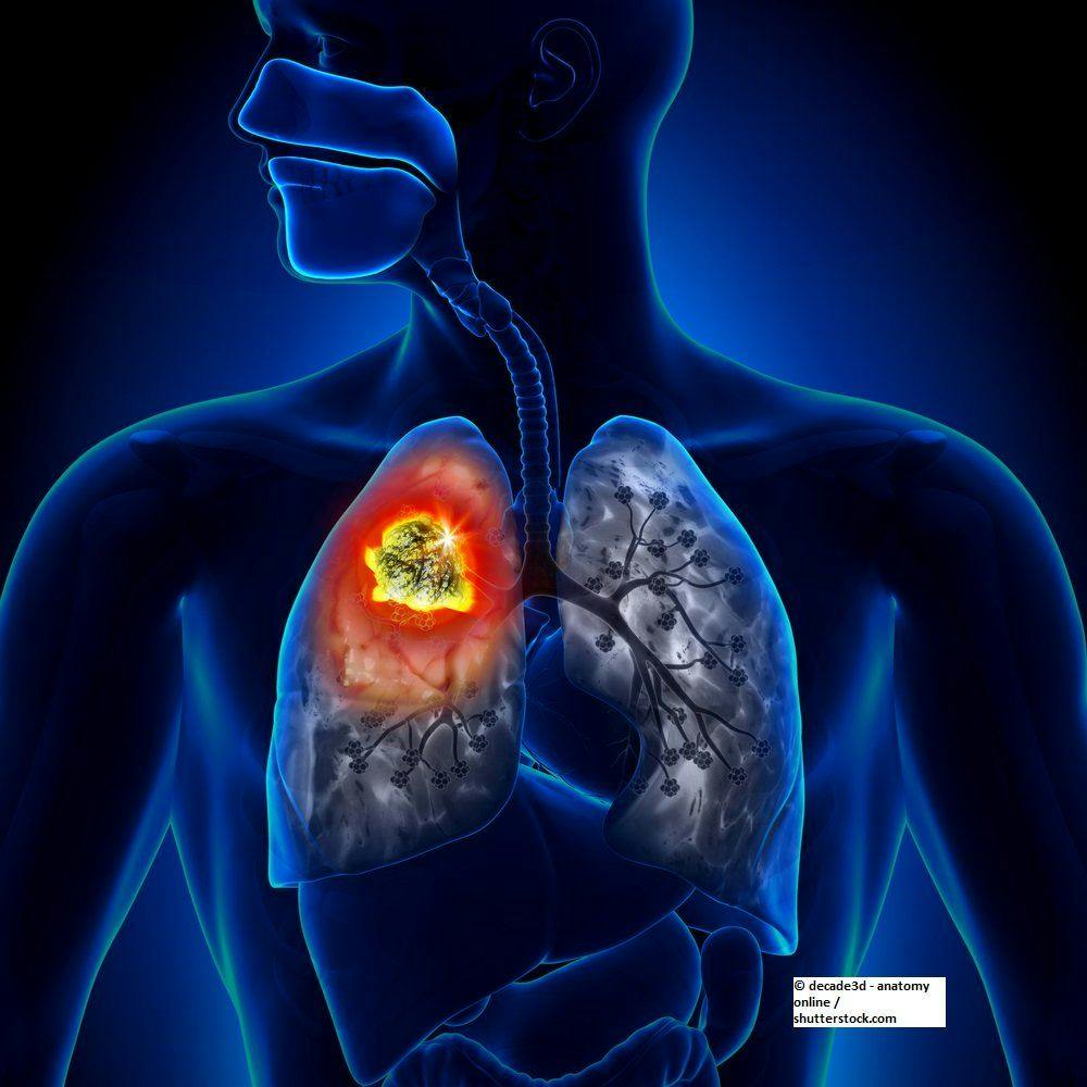 Lurbinectedin Shows Promise in Challenging Small-Cell Lung Cancer Setting