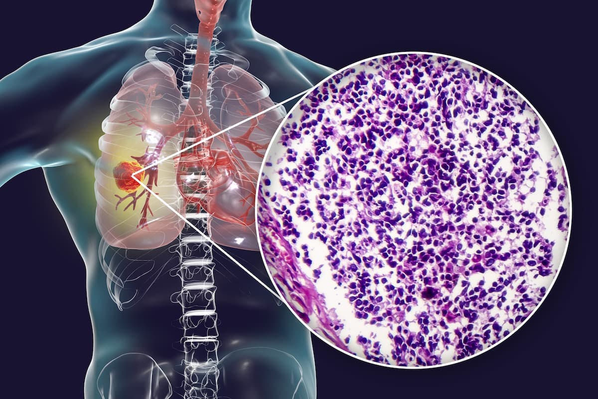 An update to the ASTRO and ESTRO clinical guidelines highlights the importance of a multidisciplinary approach to treating oligometastatic non–small cell lung cancer.