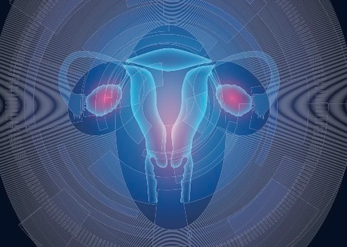 ARTISTRY-7 Will Evaluate Nemvaleukin Alpha Plus Pembrolizumab in Platinum-Resistant Ovarian Cancer