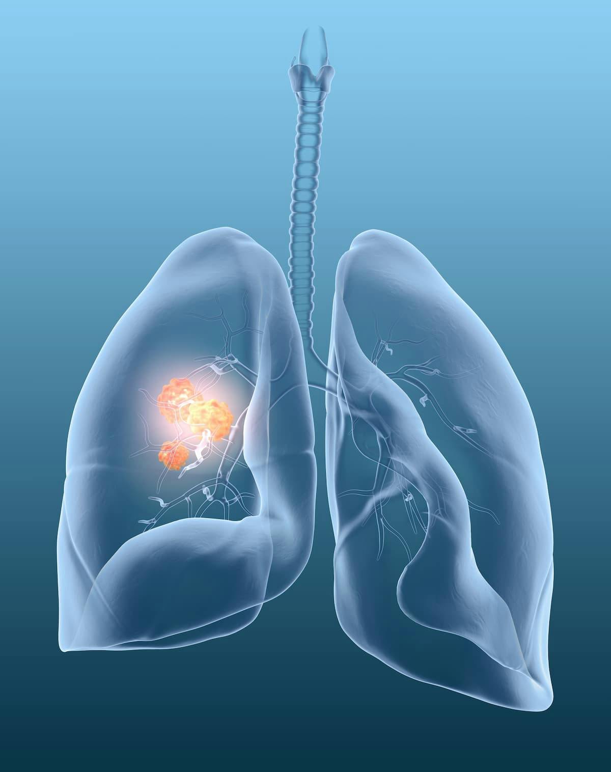 ZENITH20 Trial Has Positive Results In Untreated HER2 Exon 20-Mutant Non-Small Cell Lung Cancer