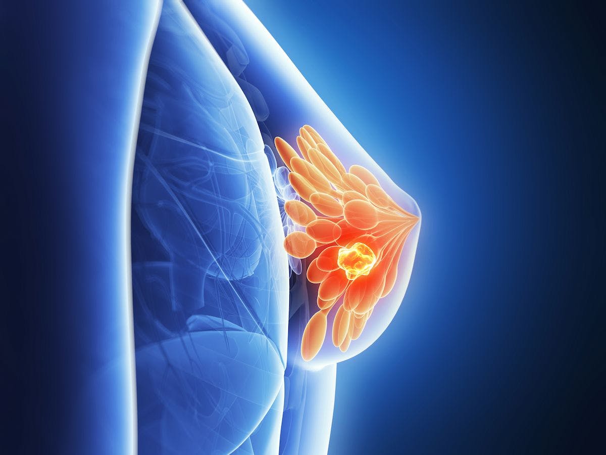 A Miami Breast Cancer Conference presentation focused on how the new ASTRO partial breast irradiation guidelines could be incorporated into practice. 