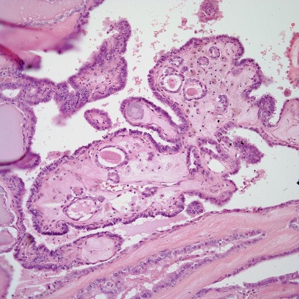 A 42-Year-Old Man With a Mass in the Thyroid Gland