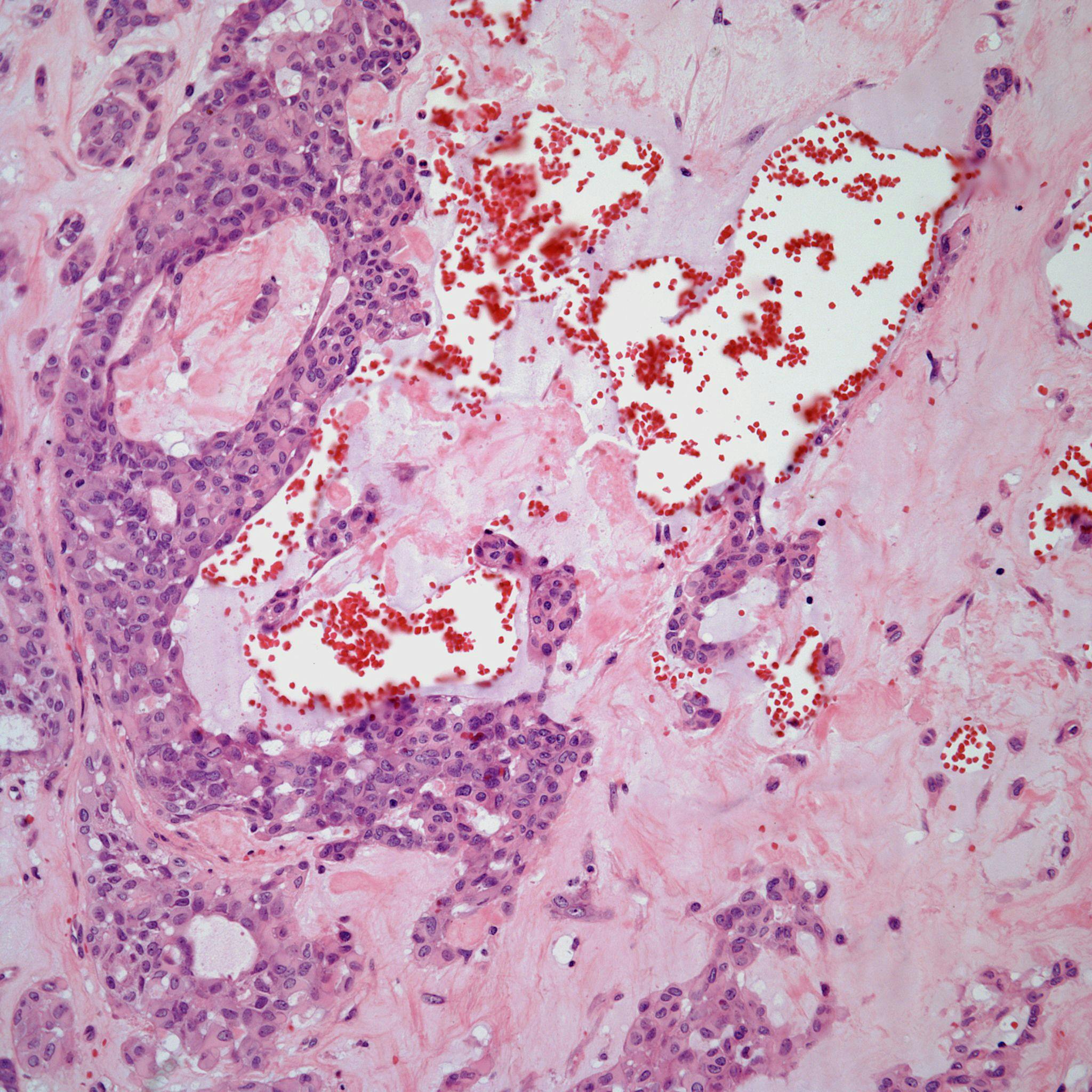  A 41-Year-Old Woman With a Mass in Her Breast