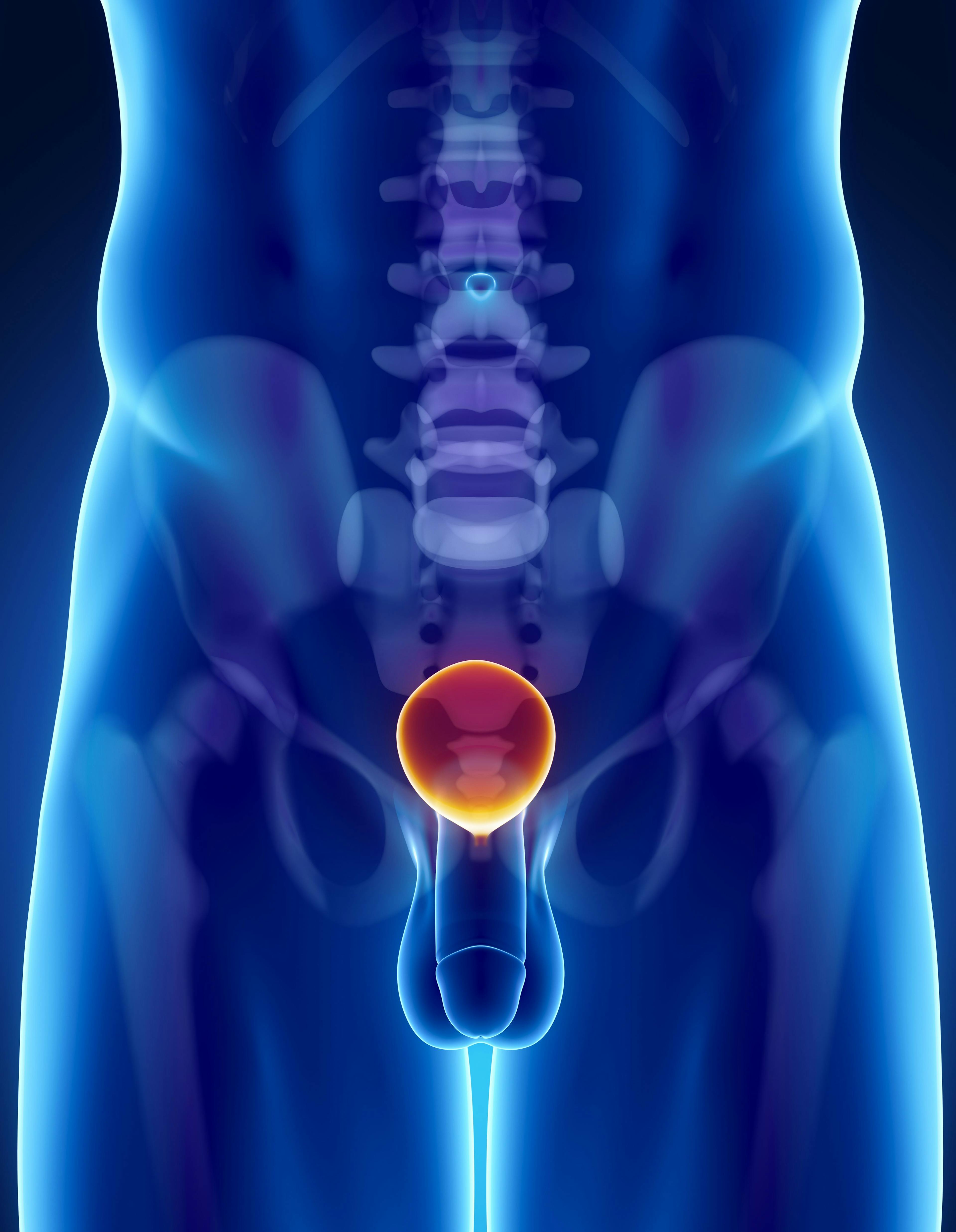 Treatment with 177Lu-PSMA-617 resulted in poor outcomes for patients with metastatic castration-resistant prostate cancer whose tumors had little to no prostate-specific membrane antigen expression.