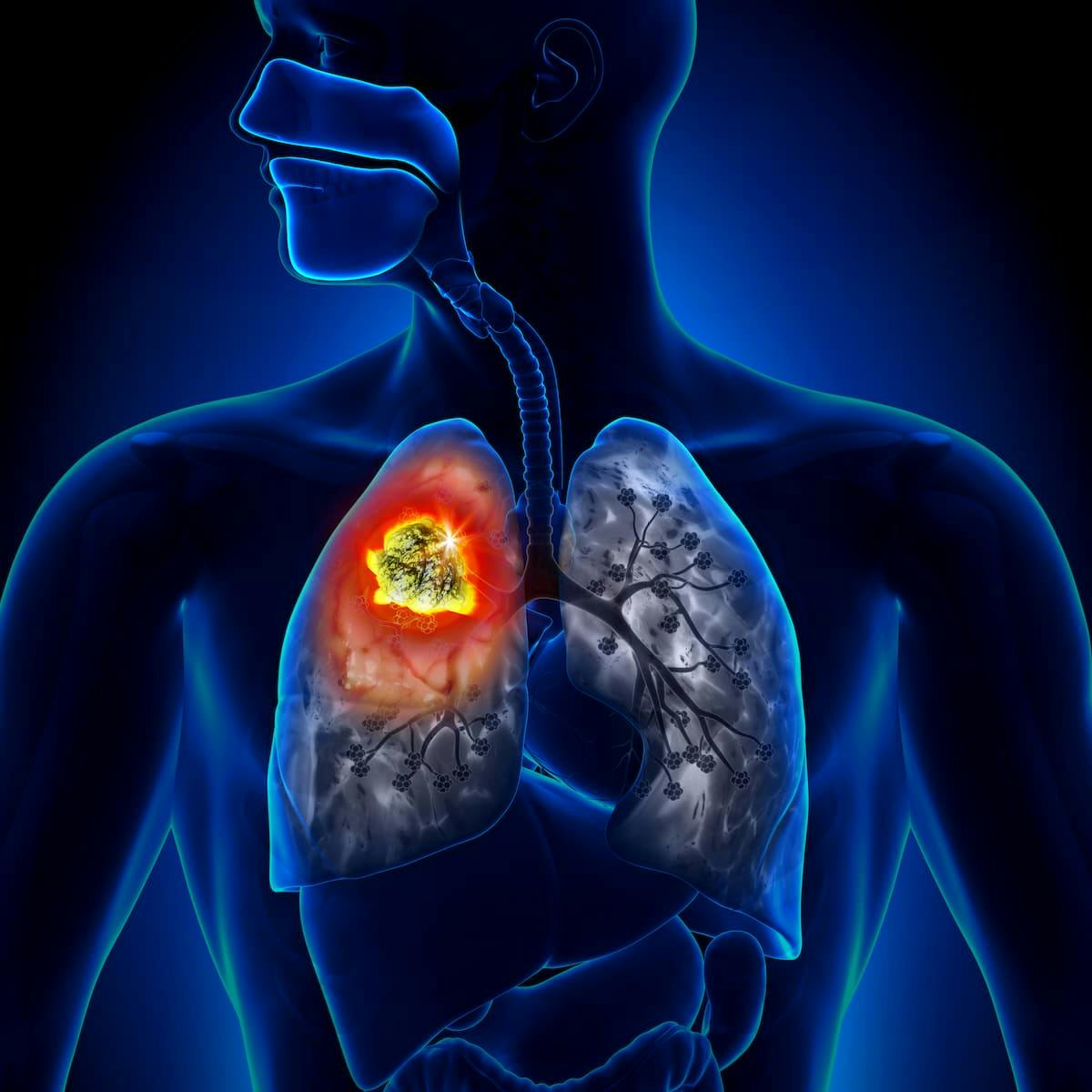 Data from the phase 3 KEYNOTE-671 trial support the European Commission’s approval of pembrolizumab plus chemotherapy for those with resectable non–small cell lung cancer.