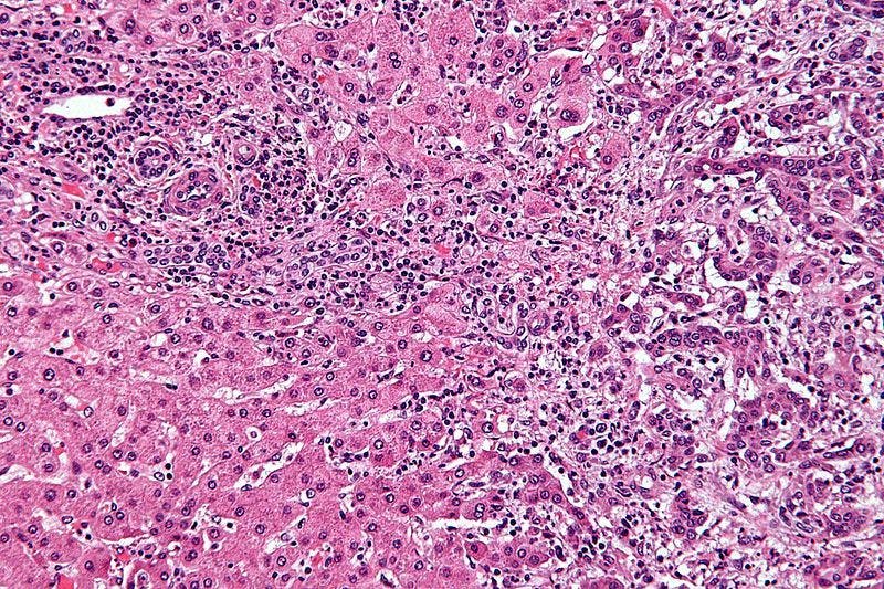 High magnification micrograph of cholangiocarcinoma