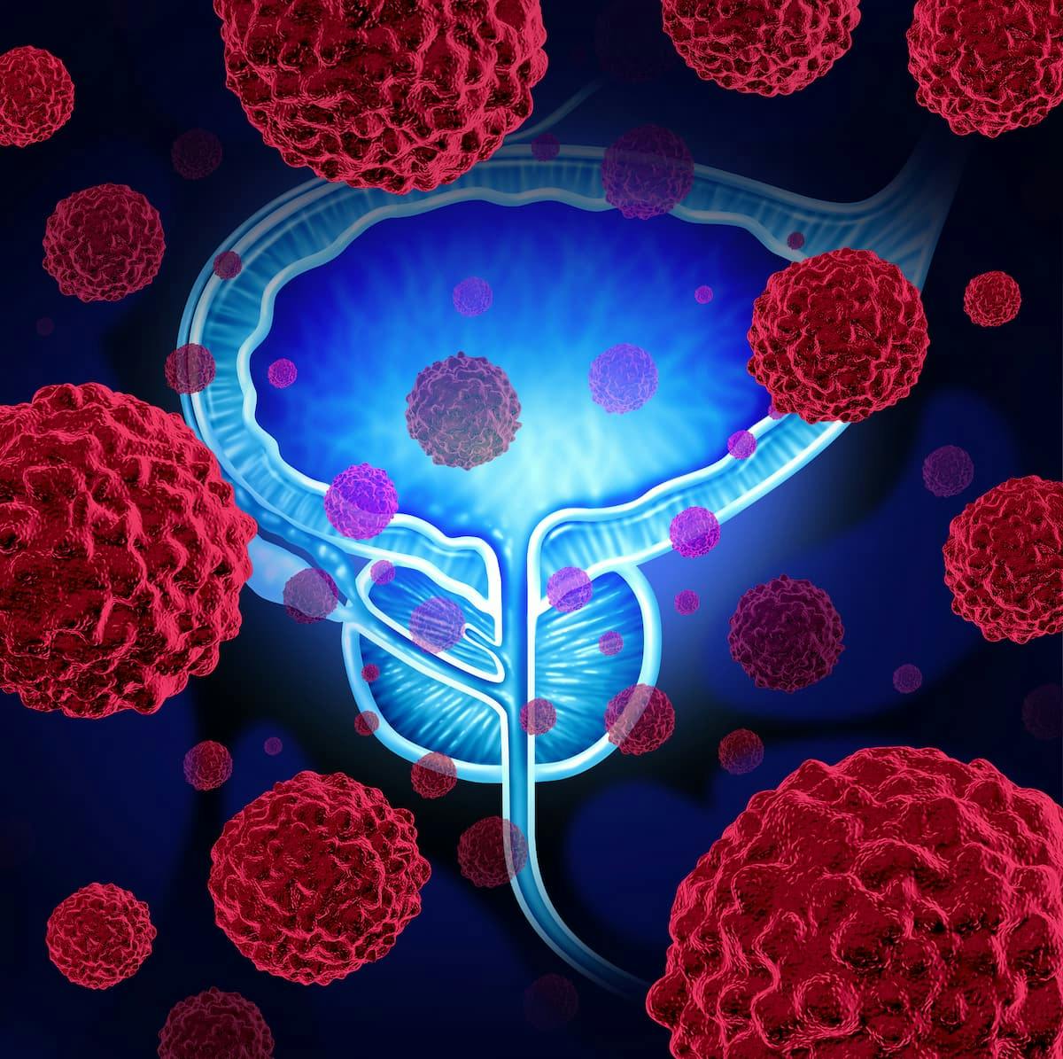 In addition to the benefit seen with hormone therapy plus metastasis-directed radiation in oligometastatic prostate cancer, use of intermittent hormone therapy may result in positive disease control and longer eugonadal testosterone intervals.