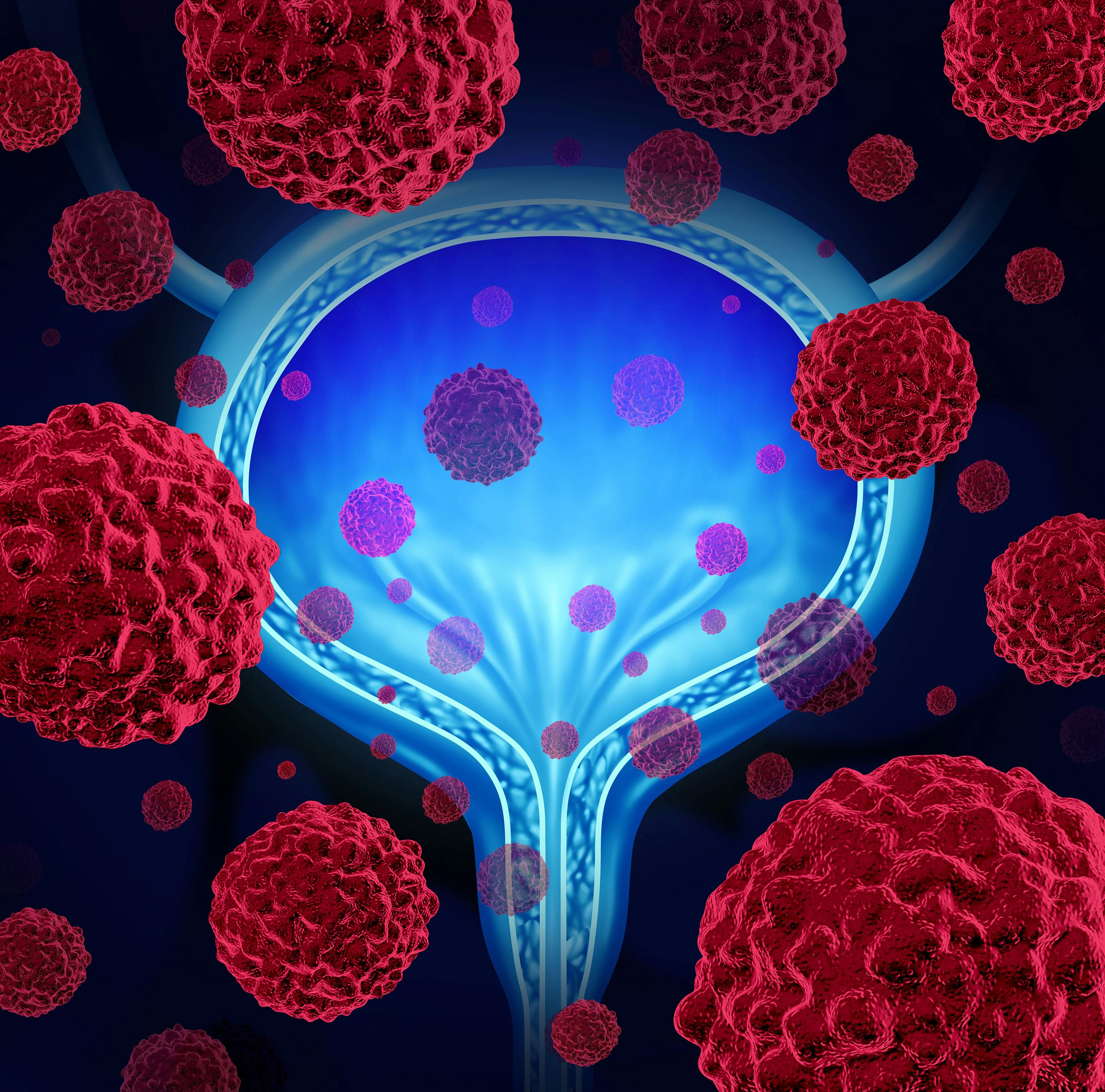 Nivolumab Granted Priority Review as Adjuvant Therapy for Muscle-Invasive Urothelial Carcinoma