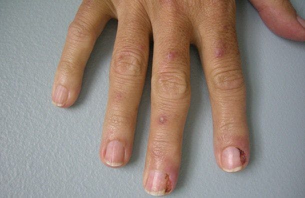 A 75-Year-Old Male Develops Painful Erythema Around His Nails After Starting Treatment