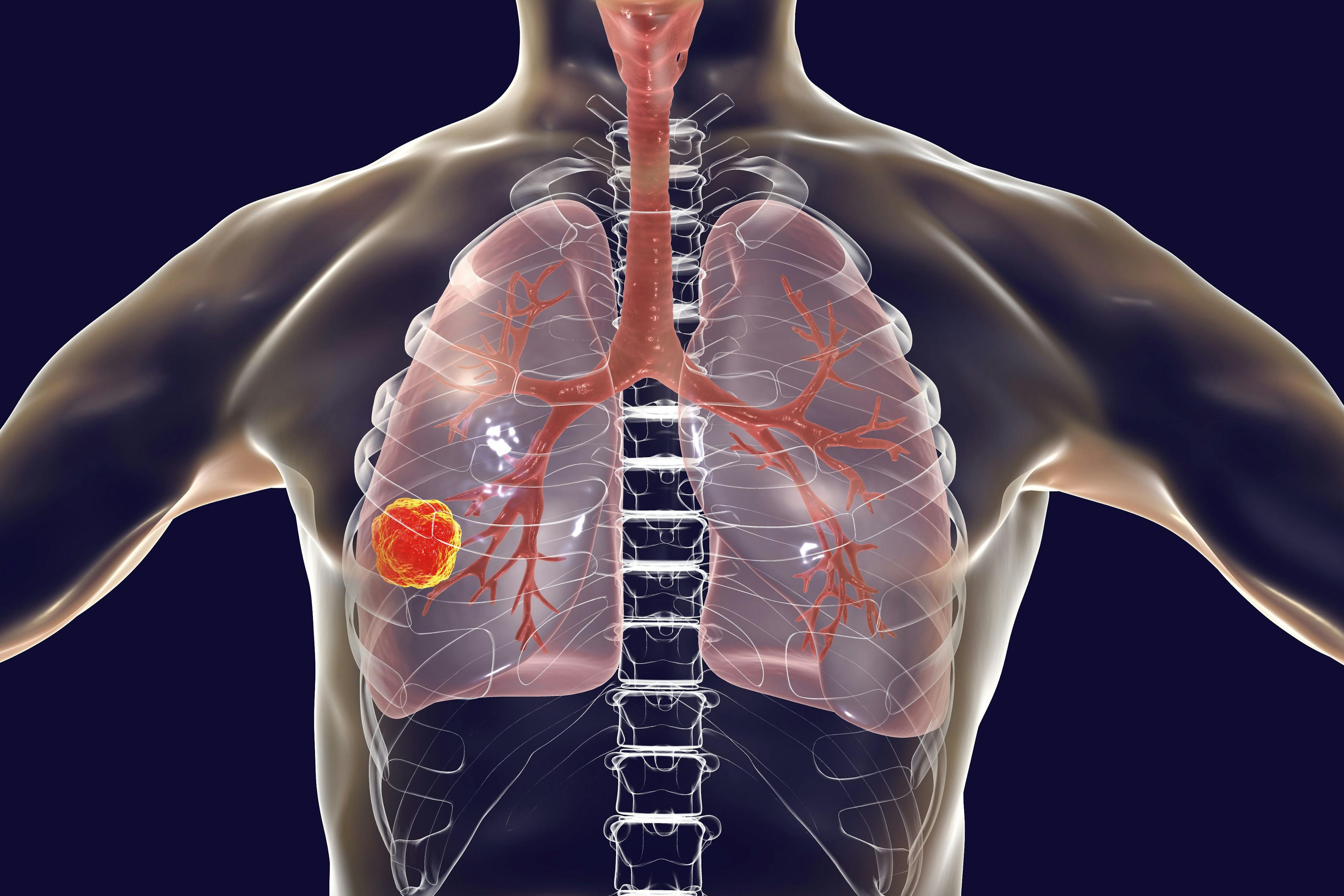 Illustration of a tumor in a human lung