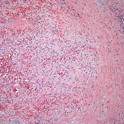 A 52-Year-Old Woman With Splenomegaly