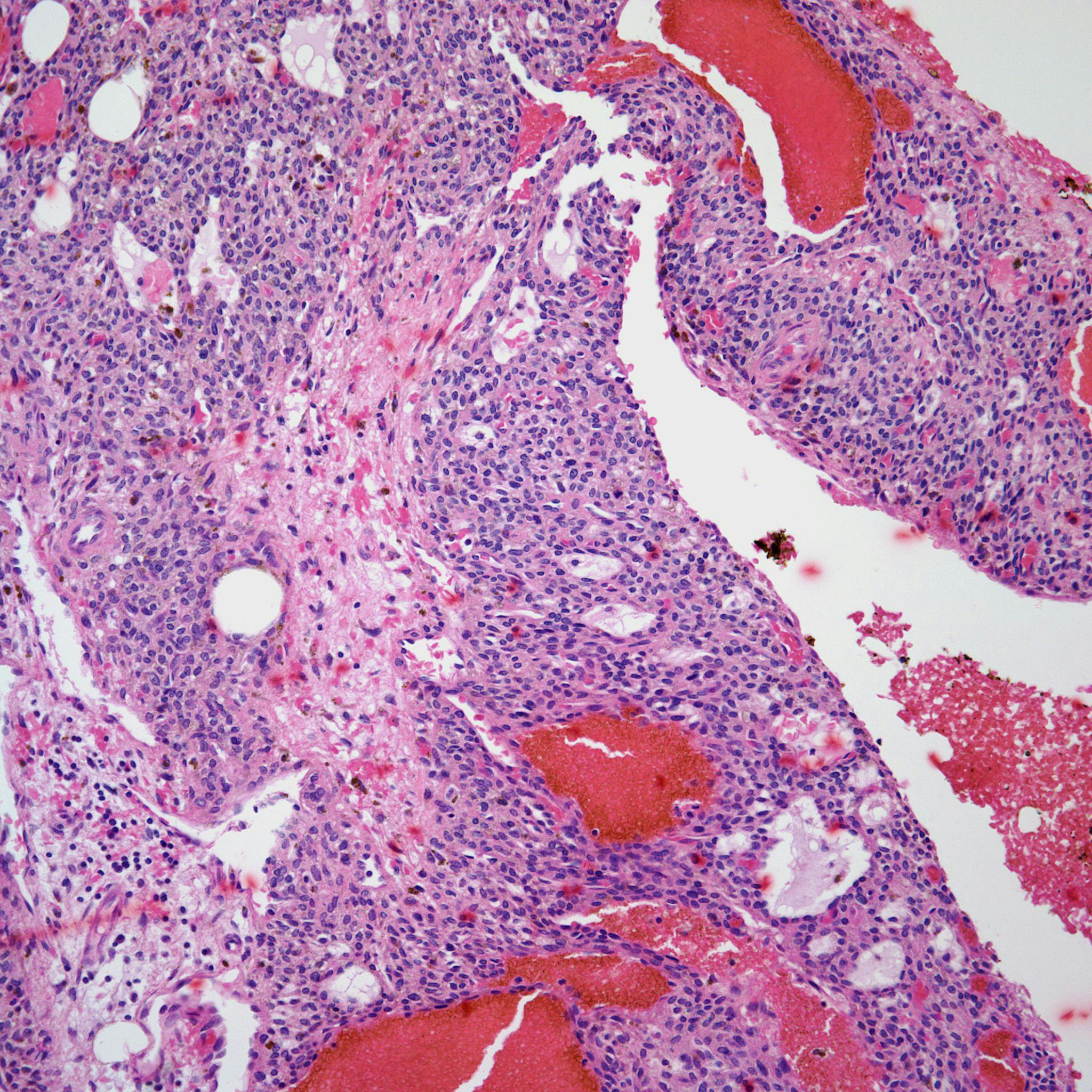 A 48-Year-Old Man With A Soft Tissue Tumor 