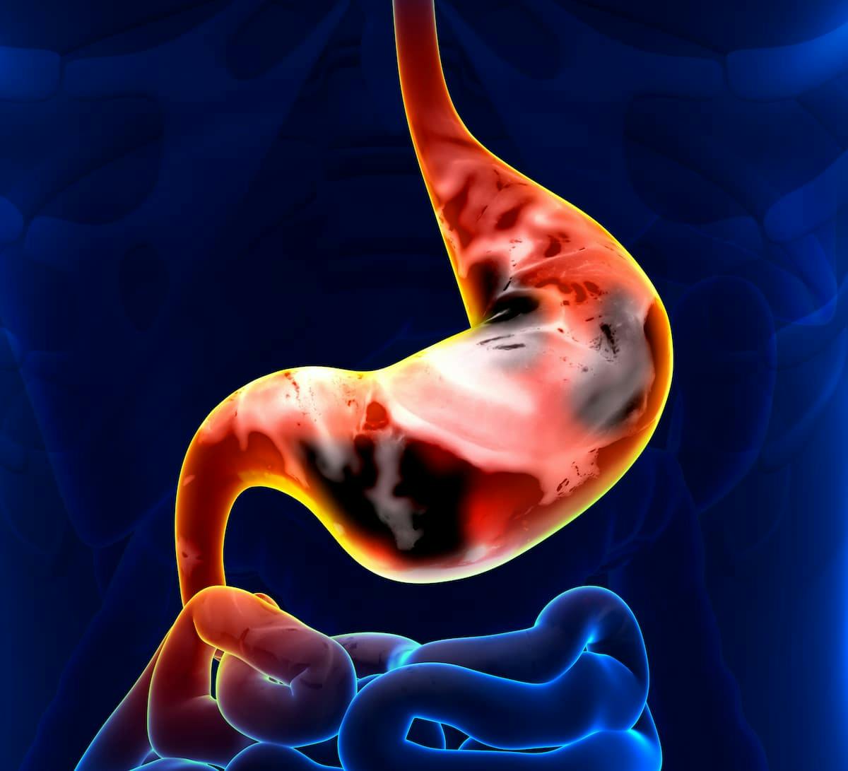 “The study demonstrated an encouraging efficacy and manageable safety profile of neoadjuvant sintilimab plus FLOT in HER2-negative locally advanced gastric/GEJ cancer, which suggested a potential therapeutic option for this population,” according to the study authors.