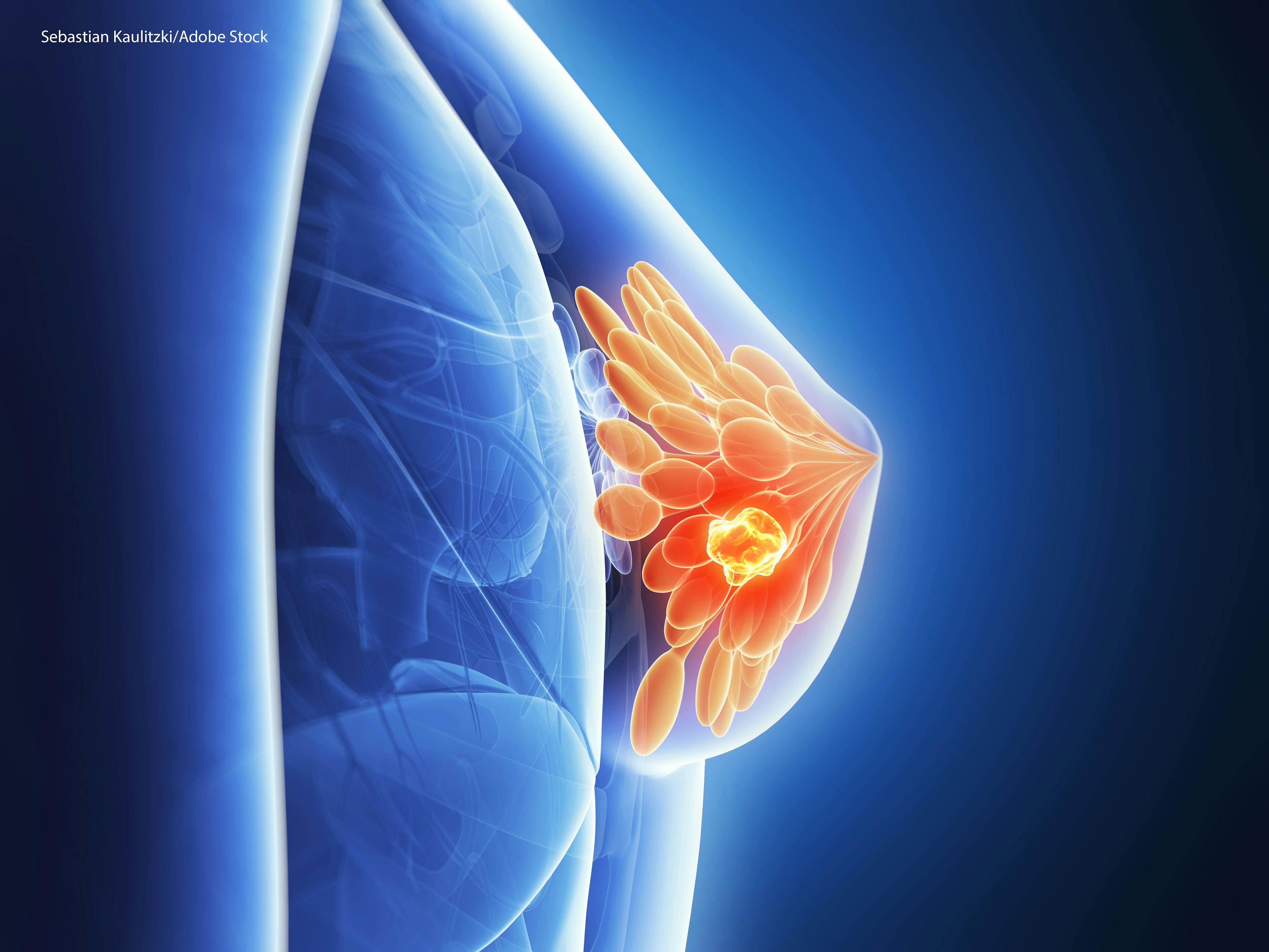 Pembrolizumab Plus Chemo Boosts Response in Triple-Negative Breast Cancer