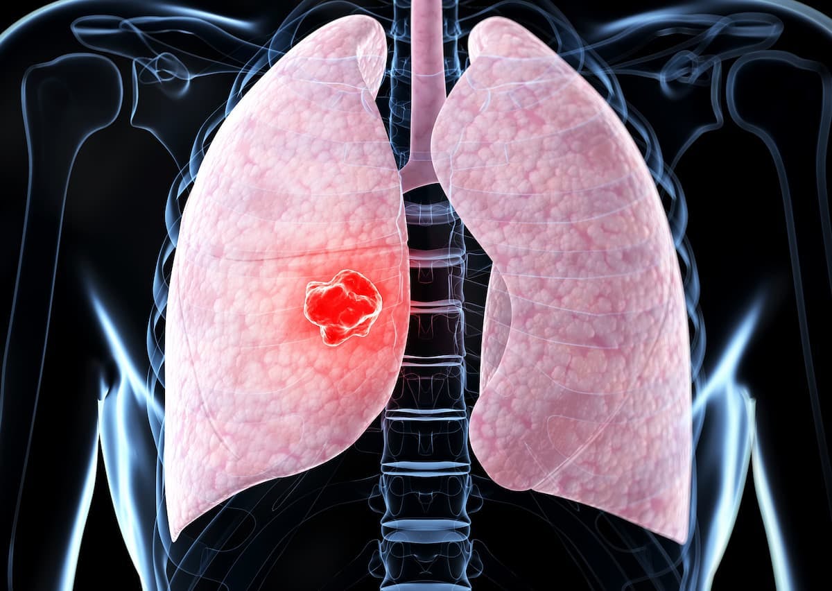 Data from the phase 2 EVOKE-02 trial support further assessment of sacituzumab govitecan plus pembrolizumab as a frontline treatment for metastatic non–small cell lung cancer.