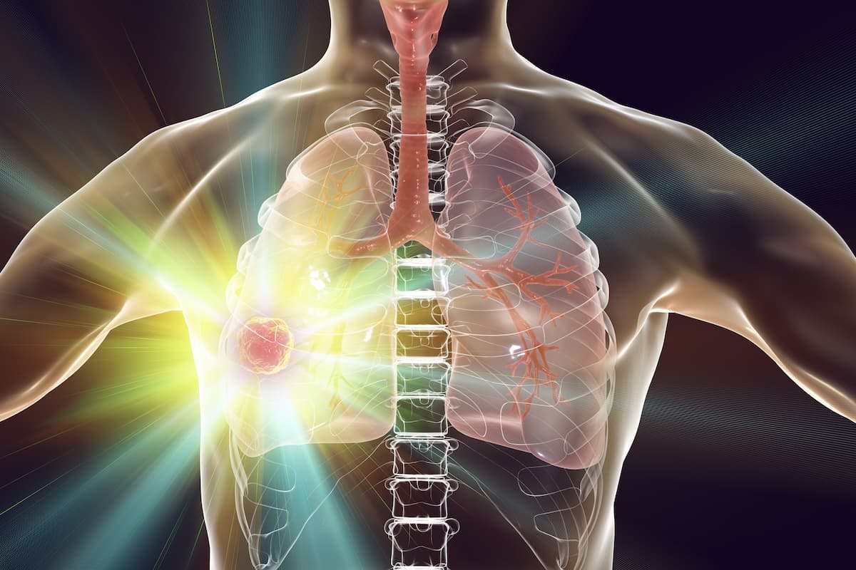 Confirmatory results from the phase 3 PAPILLON study further support the FDA approval of amivantamab-vmjw for patients with locally advanced/metastatic EGFR exon 20 insertion–mutant non–small cell lung cancer.