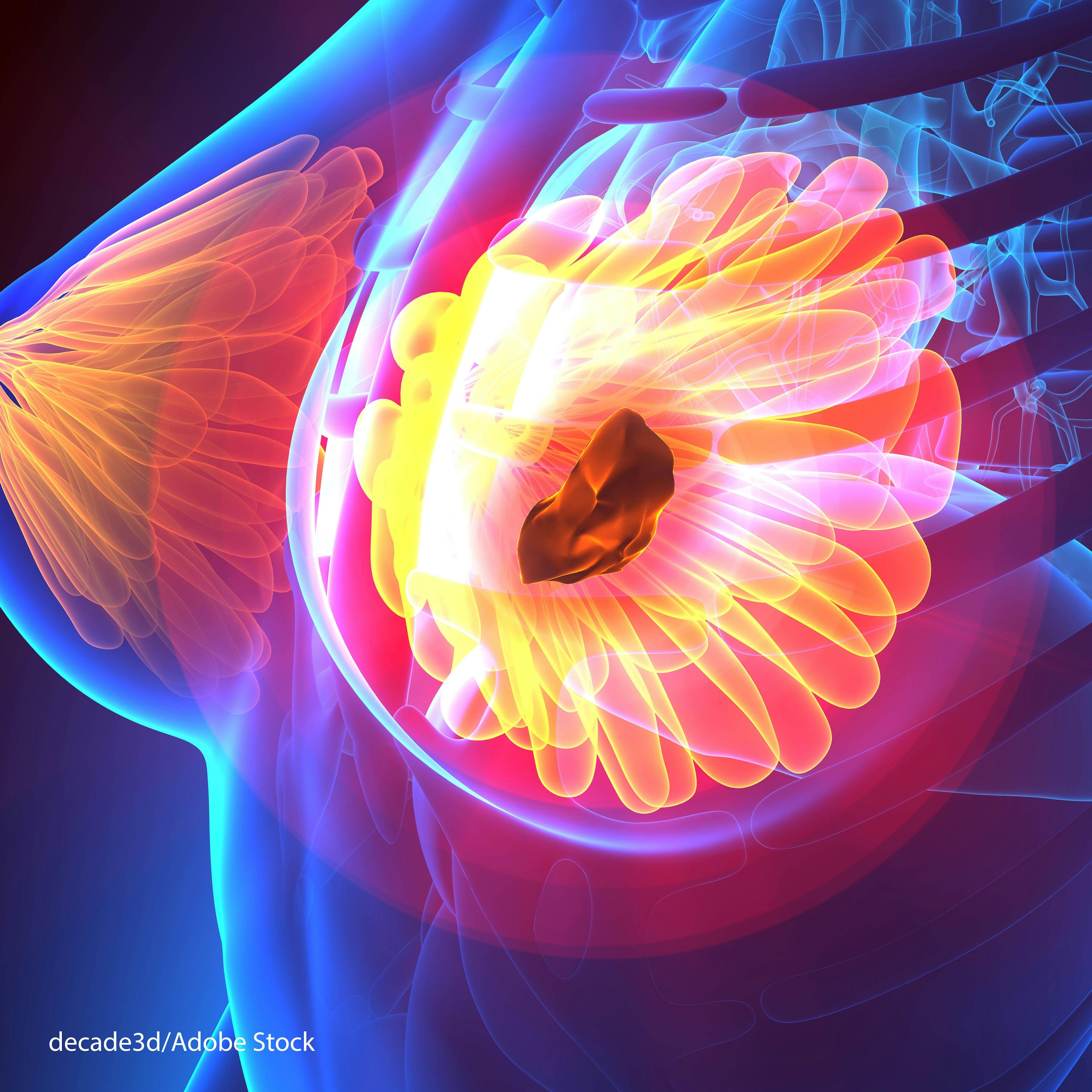  Do Nipple-Sparing Mastectomies Help Prevent Cancer Recurrence?