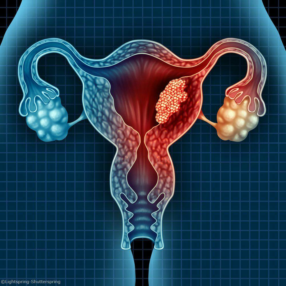 Endometrioid endometrial carcinoma