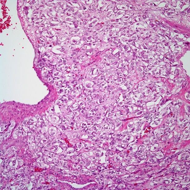 A 54-Year-Old Woman With Nausea and Vomiting