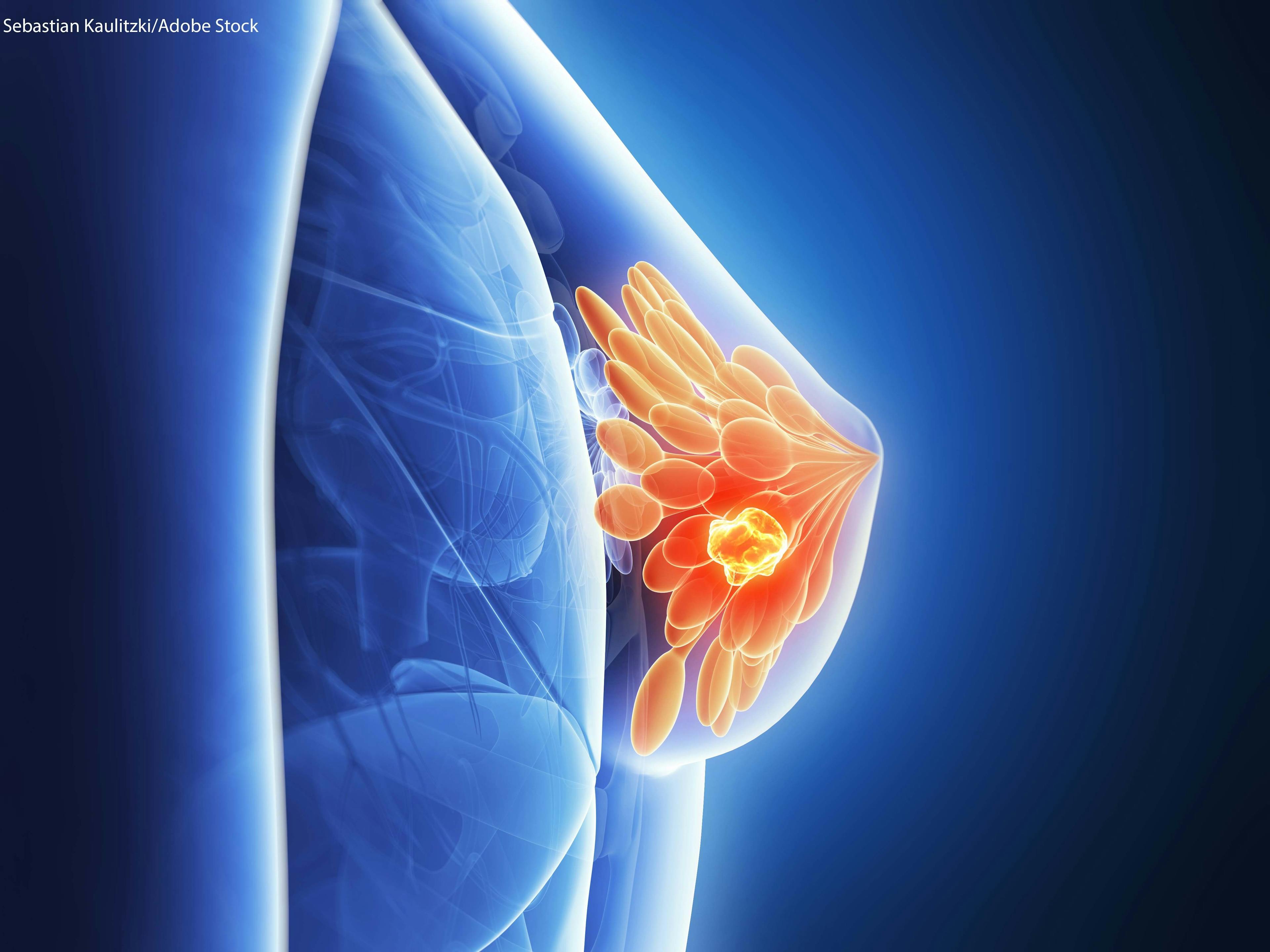 Does Adjuvant Therapy Benefit Those with Small HER2-Positive Breast Cancers?