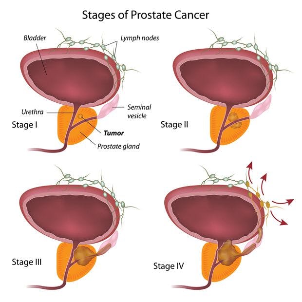 Slide Show: Prostate Cancer