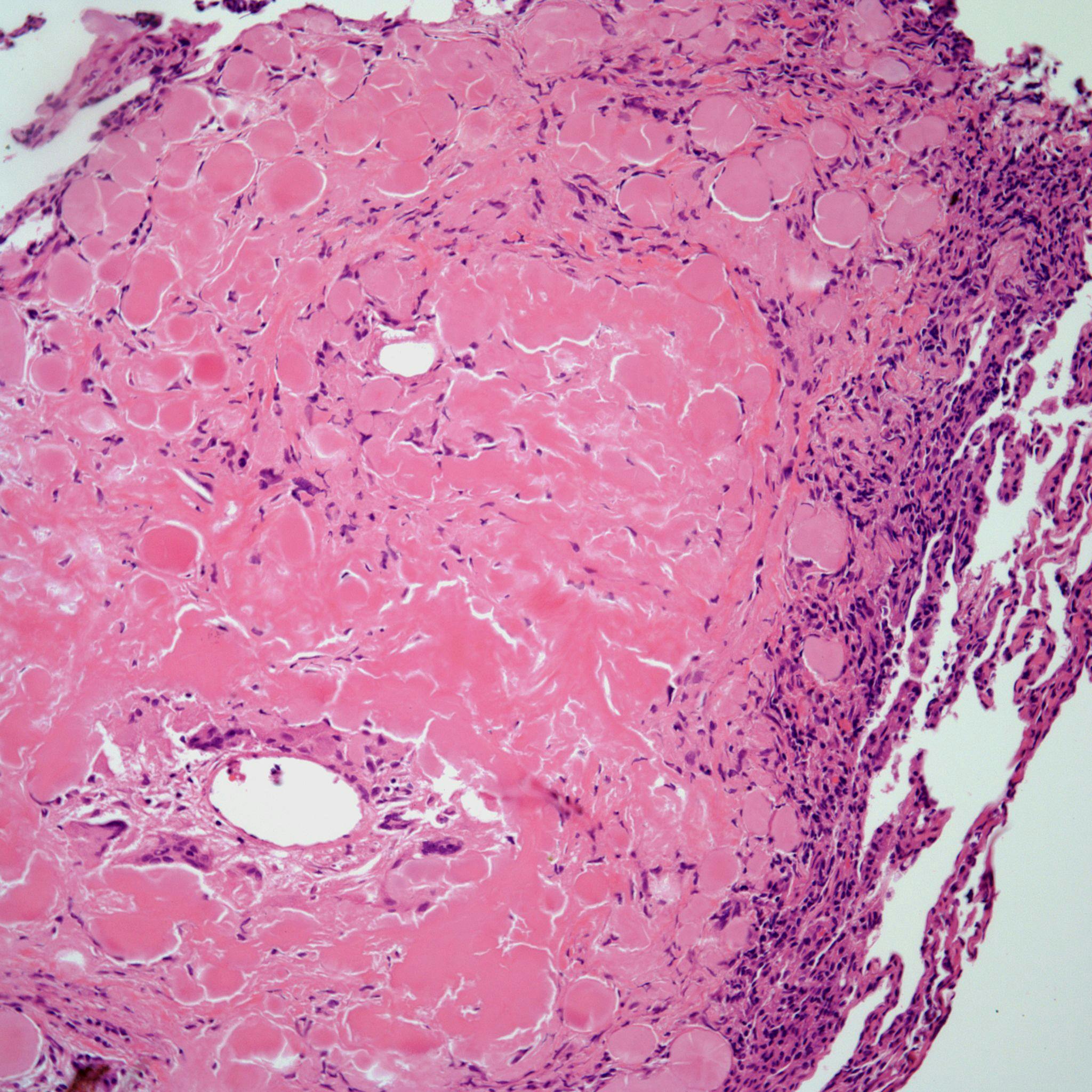 A 53-Year-Old Man With a Cough, Chest Pain, and Dyspnea 