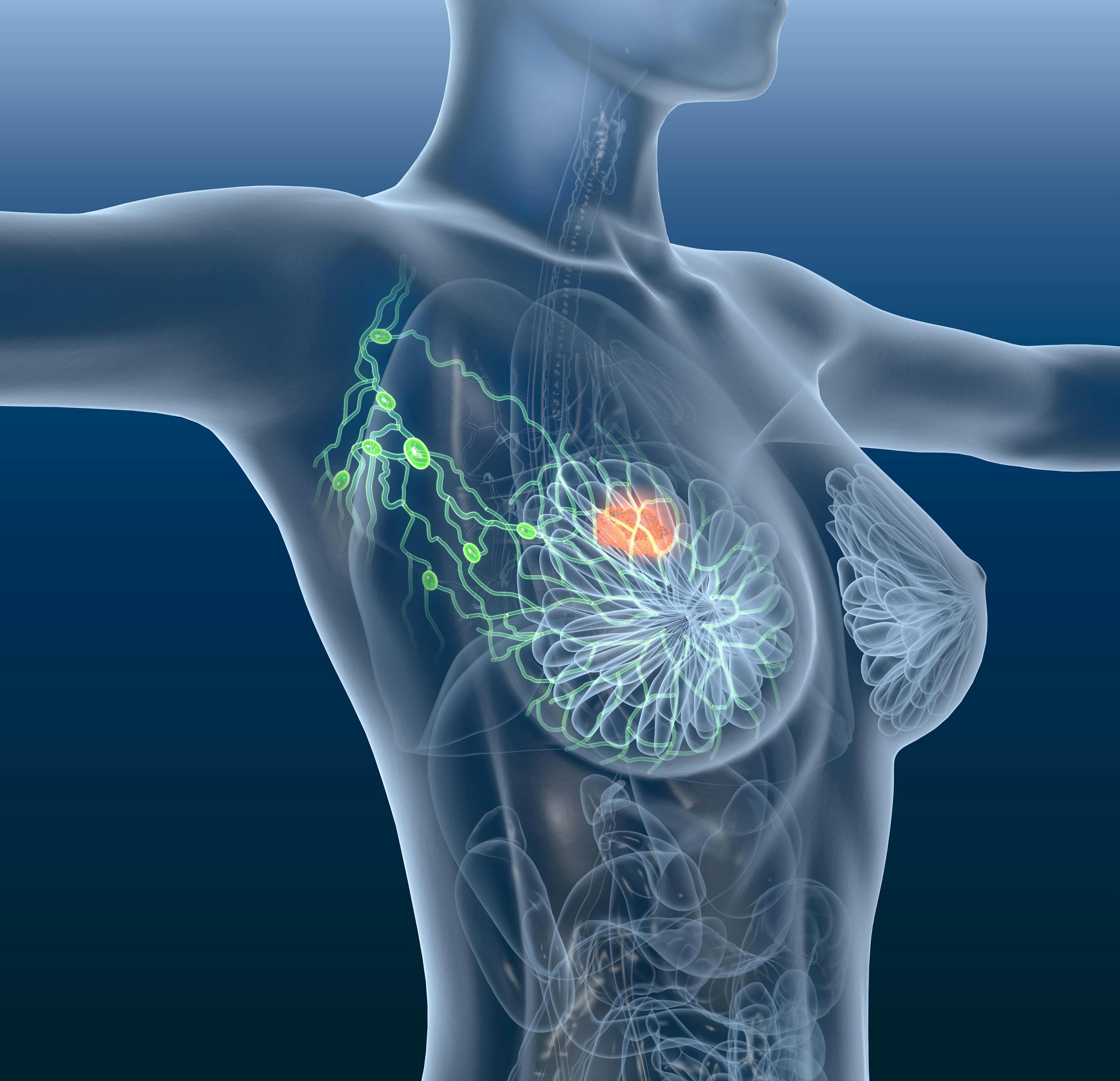 Real-World Evidence Supports Efficacy of Palbociclib Plus Letrozole in HR+/HER2– Breast Cancer
