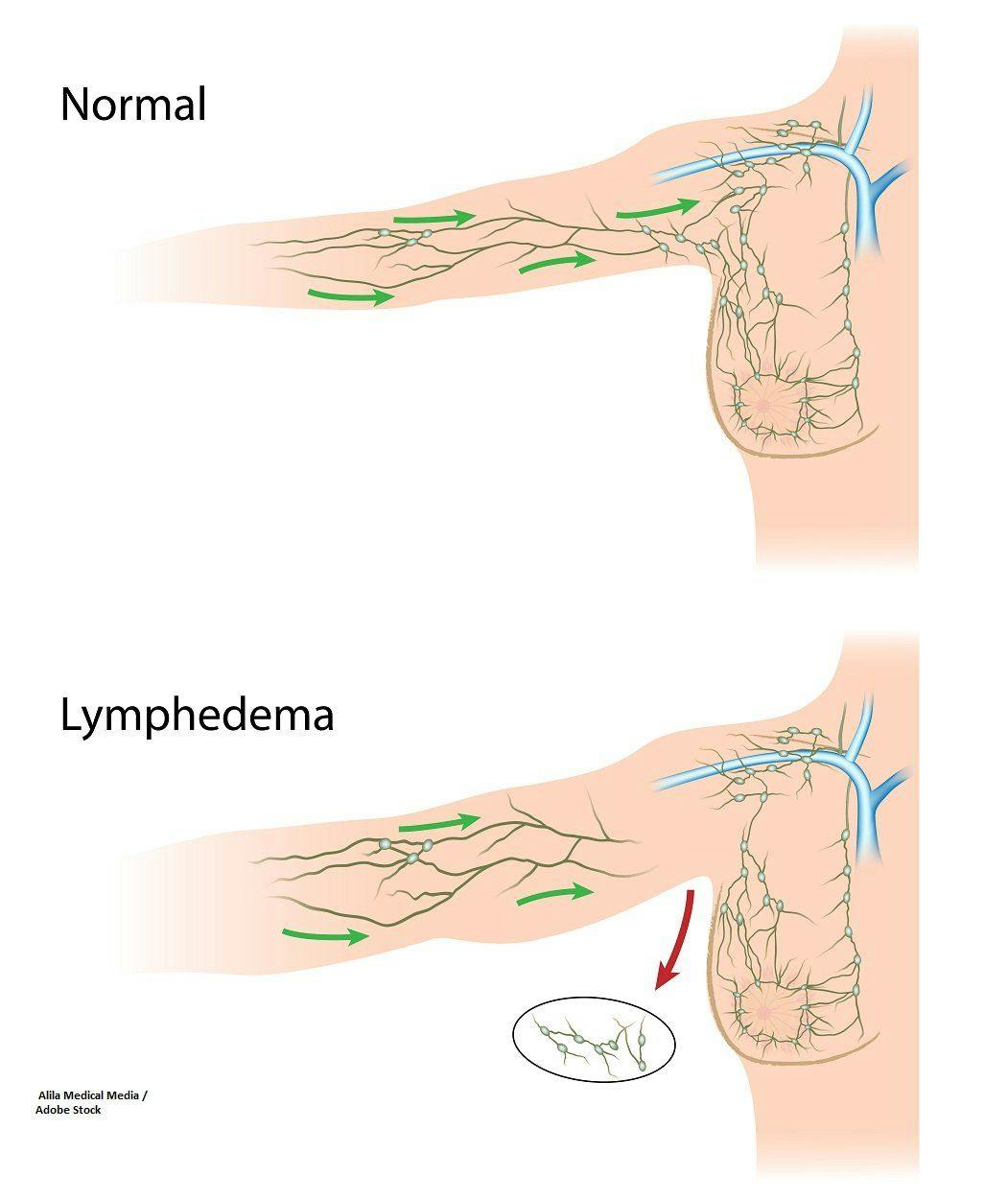lymphedema, breast cancer