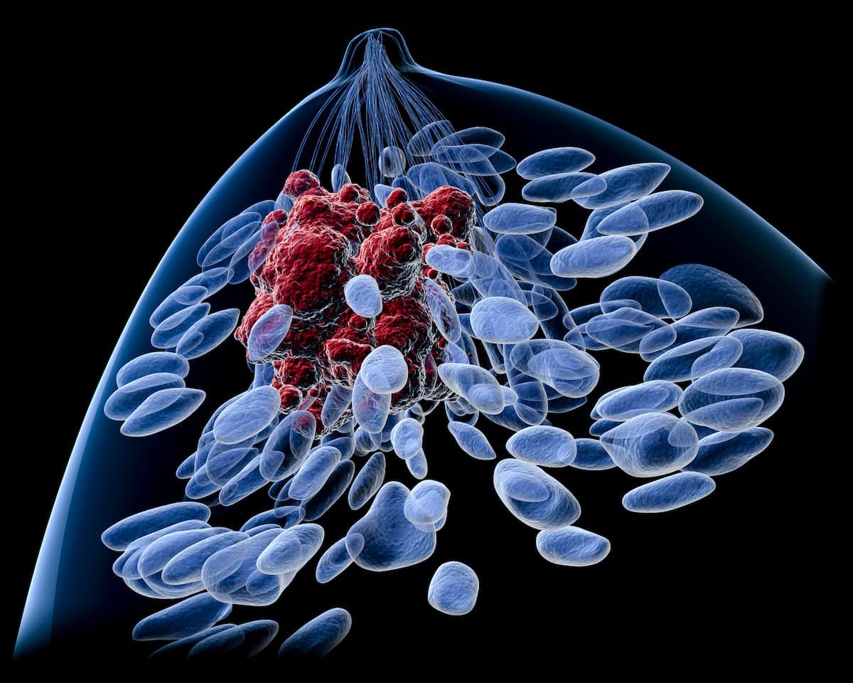 “In conclusion, together with the clinical efficacy and manageable safety profile of capivasertib plus fulvestrant, the results of this PRO analysis further support positive benefit-risk profile for the combination of capivasertib and fulvestrant in AI-resistant, HR-positive, HER2-negative advanced breast cancer,” according to Mafalda Oliveira, MD, PhD.