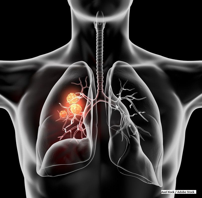 lung cancer, NSCLC