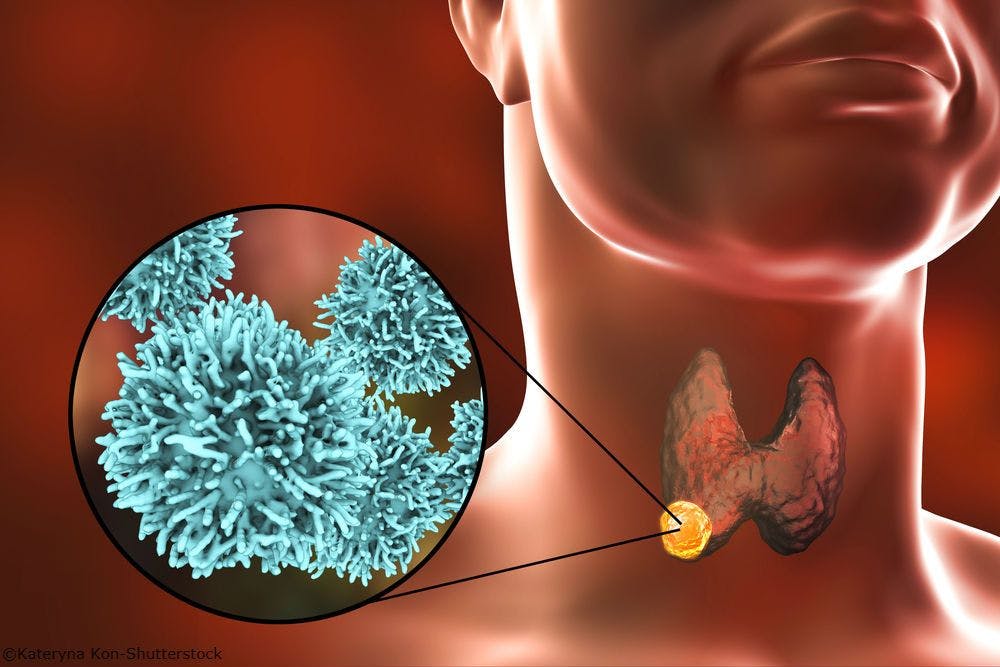 Male Sex Ups Mortality Risk in BRAF V600E Papillary Thyroid Cancer
