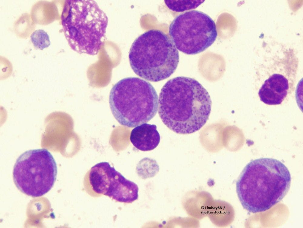 AML, leukemia, blood cancer