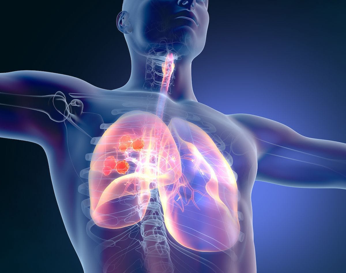 Amivantamab/chemotherapy has been recommended for approval by the CHMP in advanced non–small cell lung cancer with EGFR exon 20 insertion mutations.
