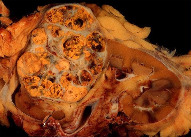 Slide Show: Renal Cell Carcinoma