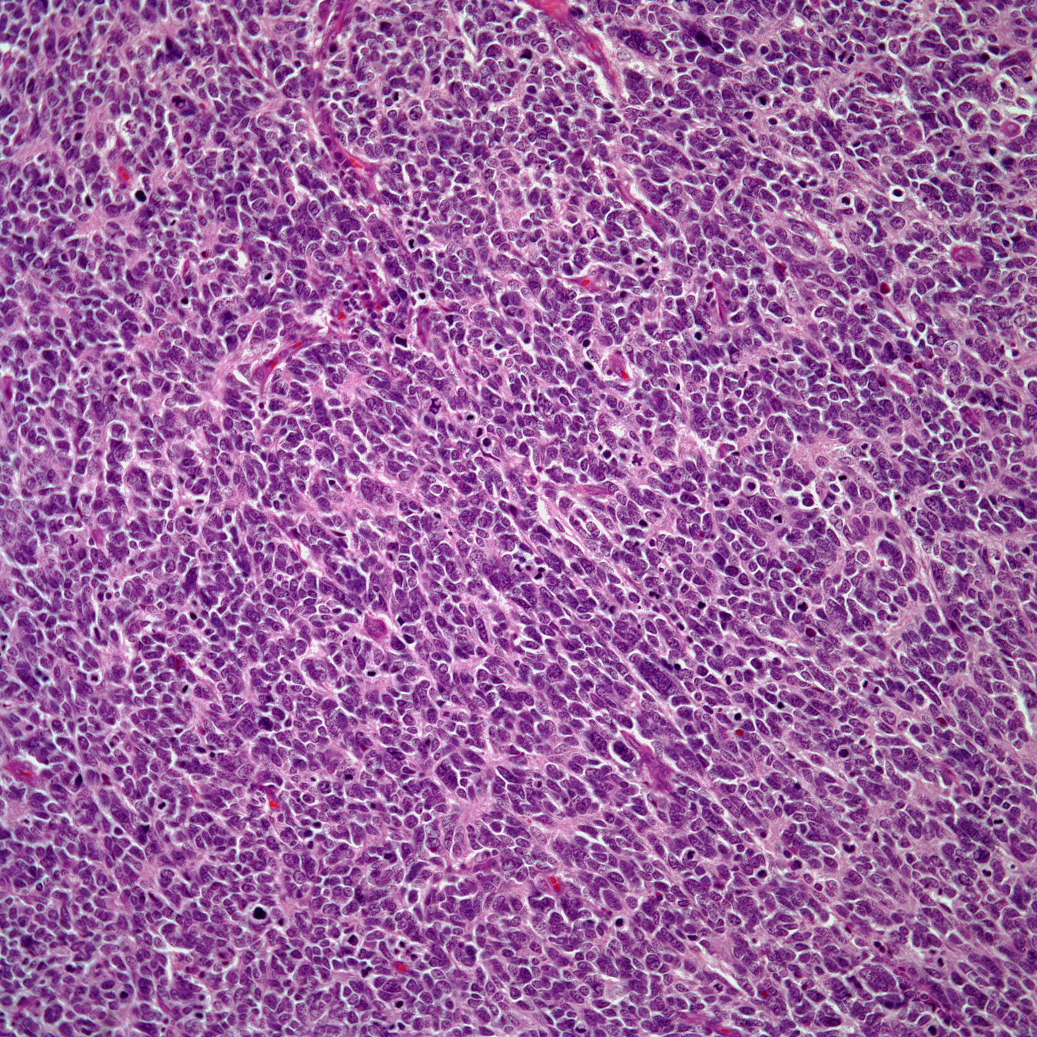 A 43-Year-Old Male With a Soft Tissue Mass