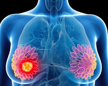 Real-World Data For Pertuzumab and T-DM1 Demonstrates Inferior Outcomes Versus HER2+ Breast Cancer Clinical Trials