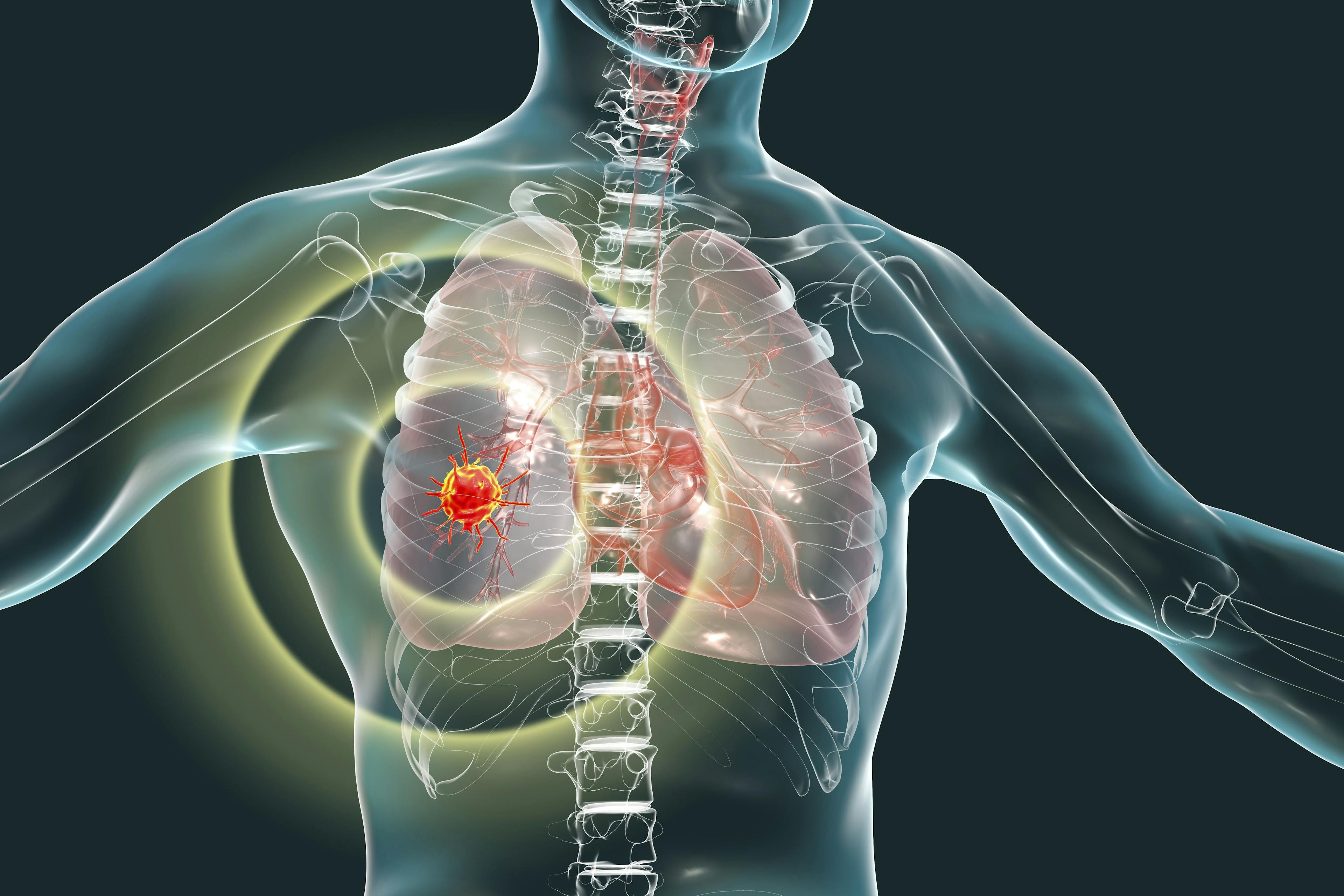 A proteogenomic analysis found savolitinib plus osimertinib elicited a response in patients with EGFR-mutated, MET-amplified advanced NSCLC.