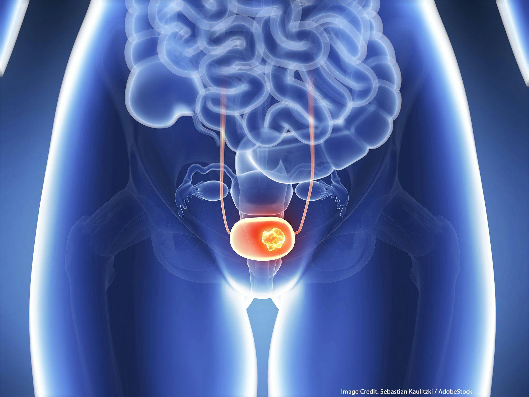 NCCN: New Bladder Cancer Guidelines Include Updated Staging, Immunotherapy Options